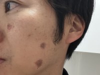 もうすぐ四十路なので、シミ取りレーザーをやってみた【雑談】